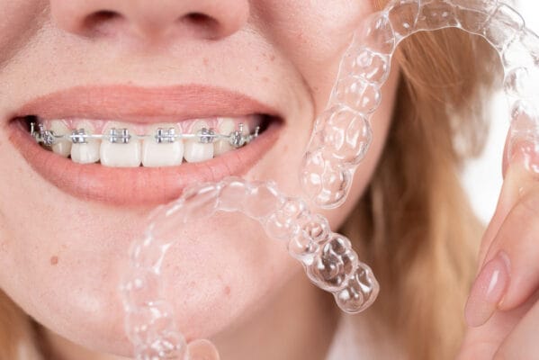 Orthodontic Options: braces and clear aligners